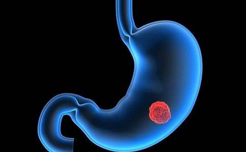 胃癌早期有哪些常见症状？早期胃癌的报警信号有哪些？